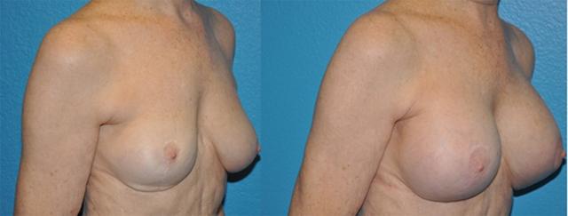 Breast Lift result at Dr. Candis Lovelace, MD, FACS in Fort Worth, TX