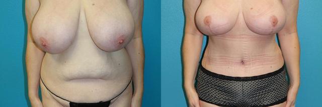 Breast Lift result at Dr. Candis Lovelace, MD, FACS in Fort Worth, TX