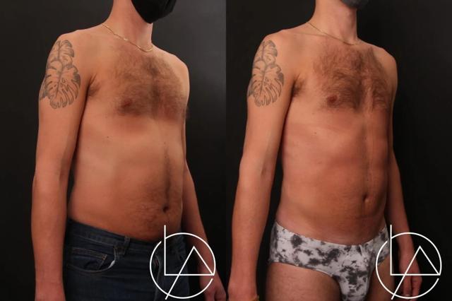 Liposuction result at Larson Plastic Surgery & Medical Aesthetics: John Larson, MD in Newport Beach, CA