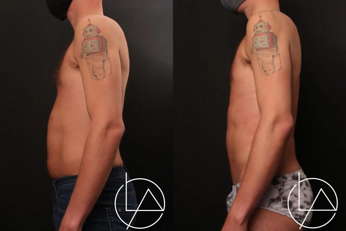 Larson Plastic Surgery & Medical Aesthetics: John Larson, MD liposuction result — Newport Beach, CA