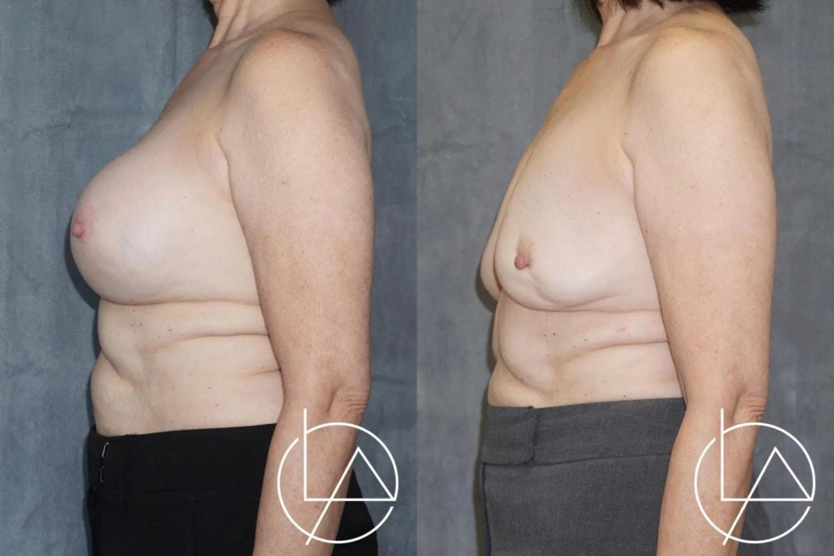 Larson Plastic Surgery & Medical Aesthetics: John Larson, MD breast implant removal result — Newport Beach, CA