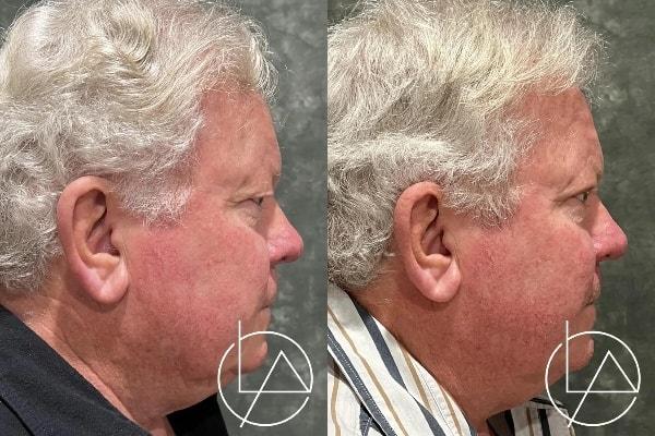 Blepharoplasty result at Larson Plastic Surgery & Medical Aesthetics: John Larson, MD in Newport Beach, CA