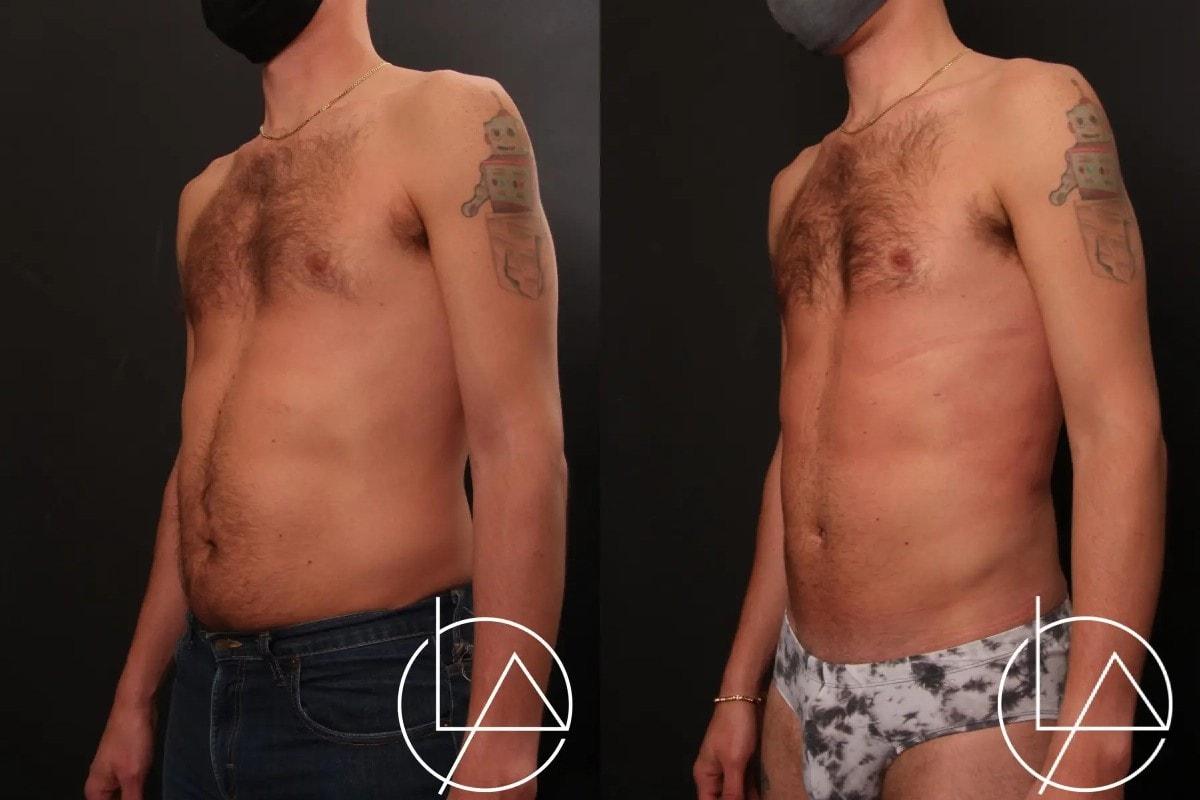 Larson Plastic Surgery & Medical Aesthetics: John Larson, MD liposuction result — Newport Beach, CA