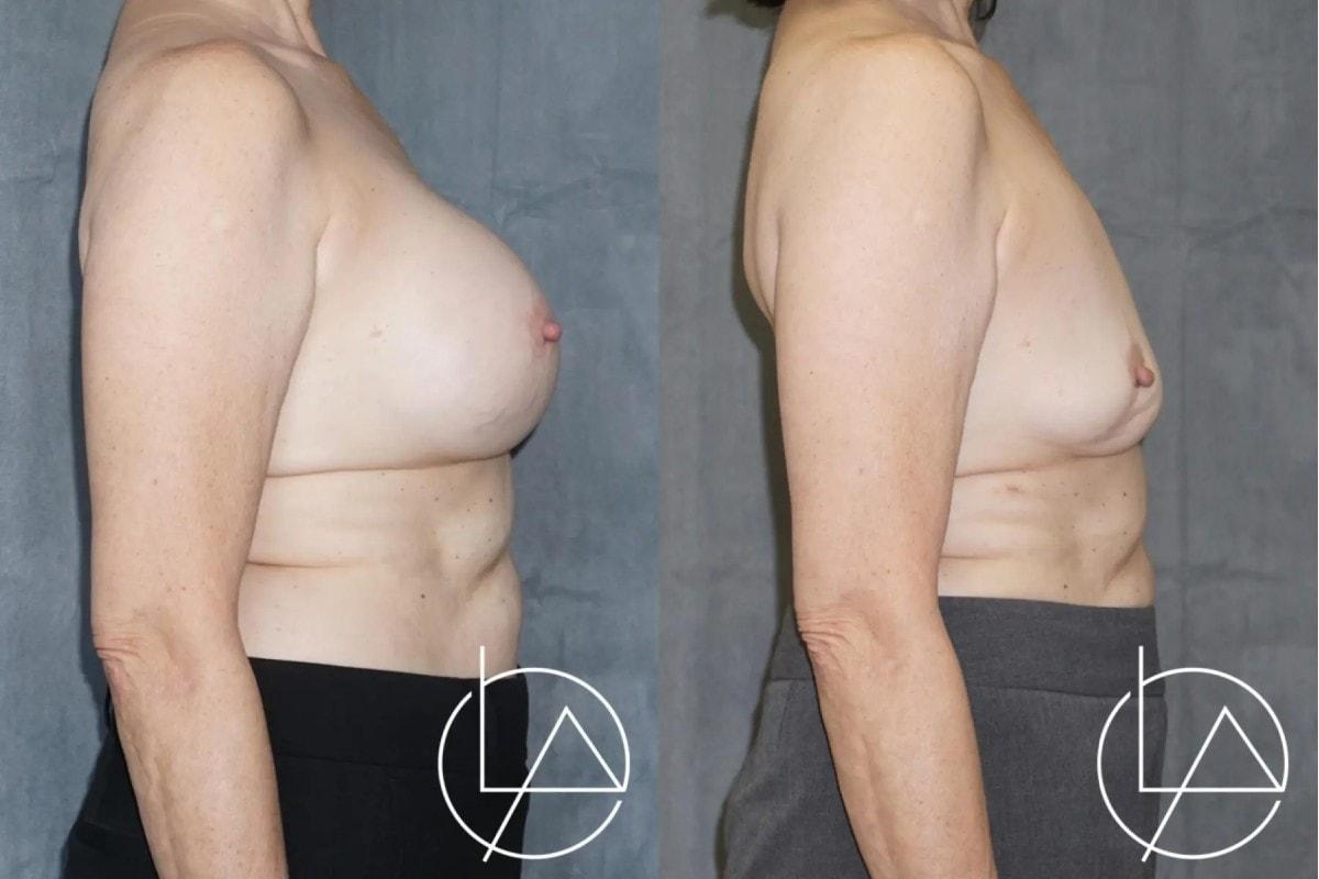 Larson Plastic Surgery & Medical Aesthetics: John Larson, MD breast implant removal result — Newport Beach, CA