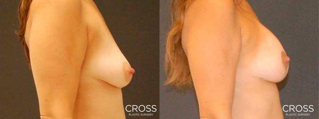 Breast Lift result at Cross Medical Group in Philadelphia, PA