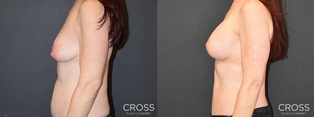 Mommy Makeover result at Cross Medical Group in Philadelphia, PA