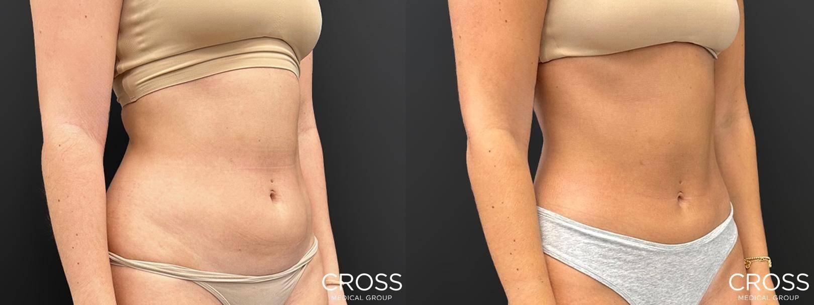 Cross Medical Group liposuction result — Philadelphia, PA