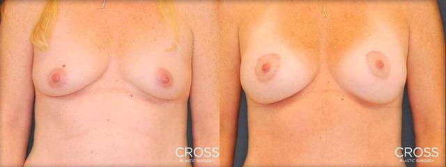 Breast Lift result at Cross Medical Group in Philadelphia, PA