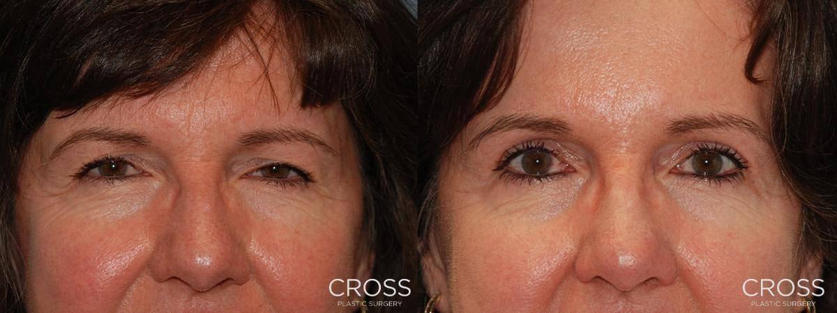 Cross Medical Group brow lift result — Philadelphia, PA