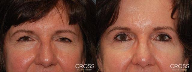 Brow Lift result at Cross Medical Group in Philadelphia, PA