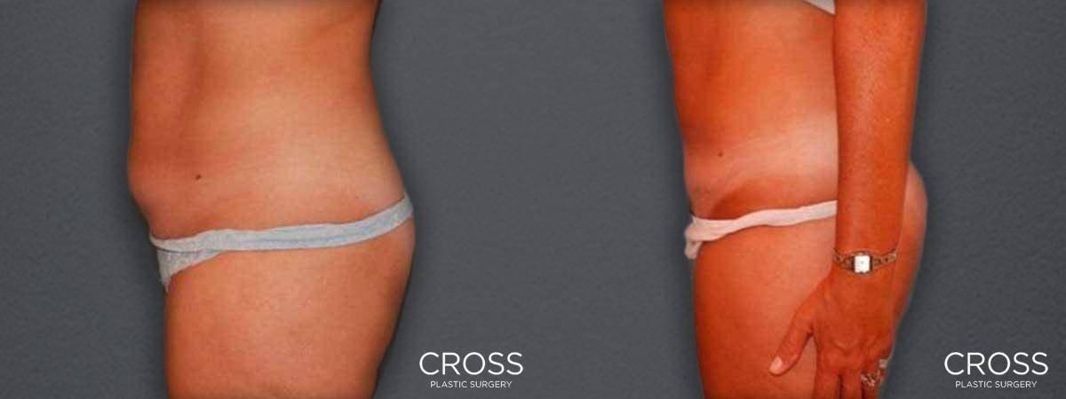 Cross Medical Group liposuction result — Philadelphia, PA