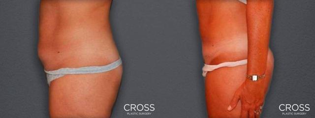Brazilian Butt Lift result at Cross Medical Group in Philadelphia, PA