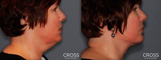 Neck Lift result at Cross Medical Group in Philadelphia, PA