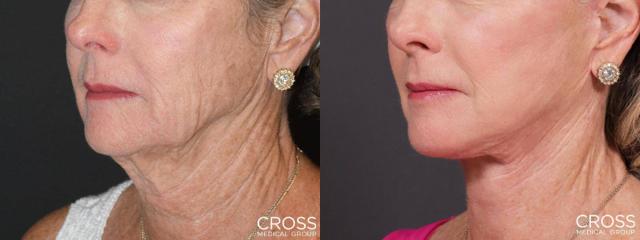 Neck Lift result at Cross Medical Group in Philadelphia, PA