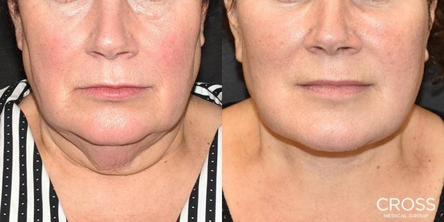 Neck Lift result at Cross Medical Group in Philadelphia, PA