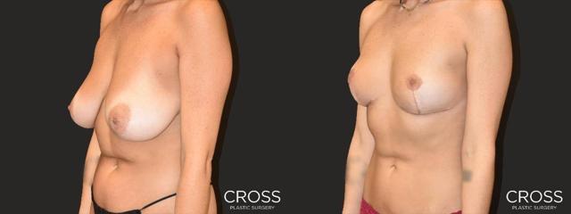 Breast Reduction result at Cross Medical Group in Philadelphia, PA