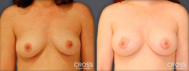 Breast Lift result at Cross Medical Group in Philadelphia, PA
