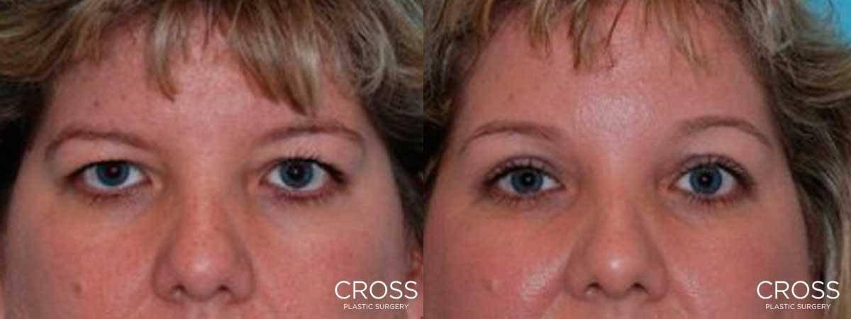 Cross Medical Group brow lift result — Philadelphia, PA