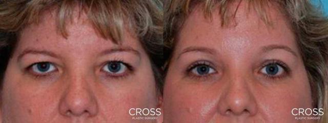 Brow Lift result at Cross Medical Group in Philadelphia, PA