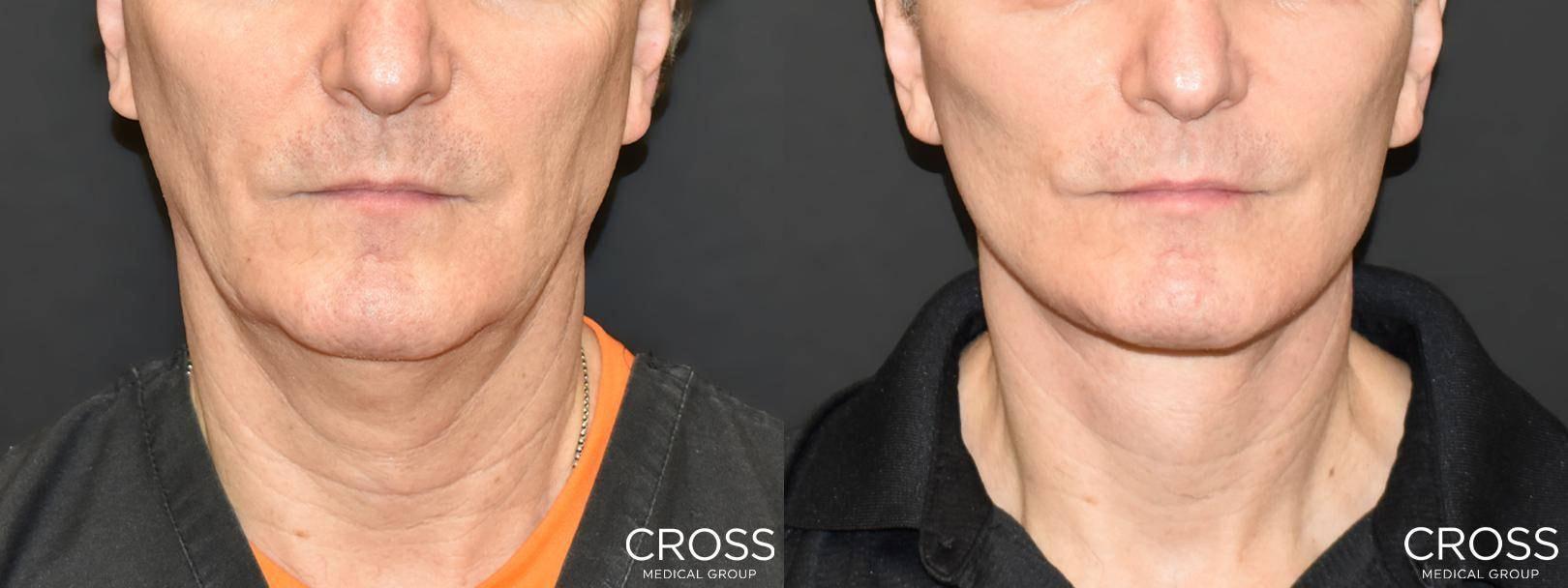 Cross Medical Group neck lift result — Philadelphia, PA