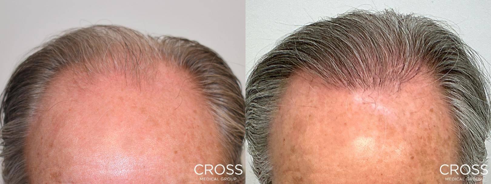 Cross Medical Group fue hair transplant result — Philadelphia, PA