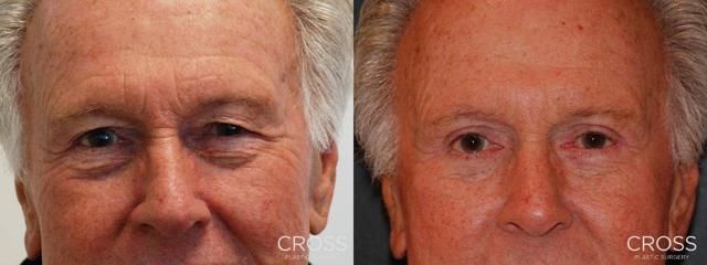 Blepharoplasty result at Cross Medical Group in Philadelphia, PA