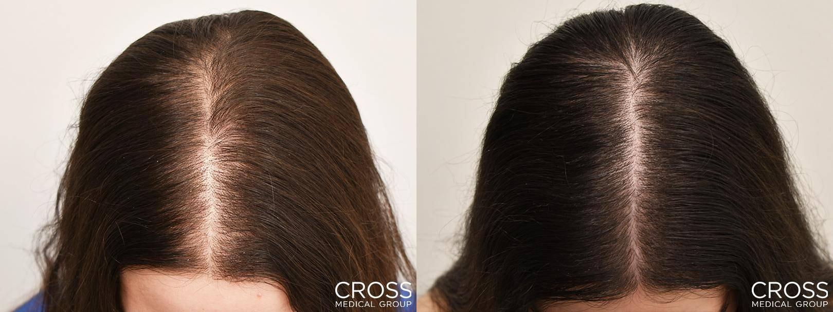 Cross Medical Group fue hair transplant result — Philadelphia, PA