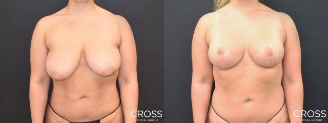 Breast Reduction result at Cross Medical Group in Philadelphia, PA