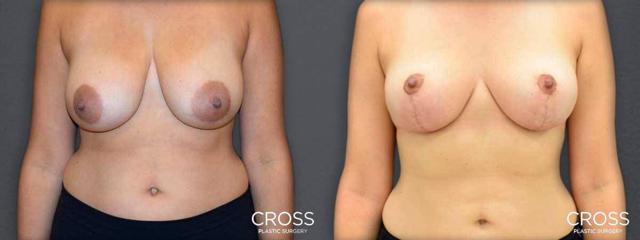 Breast Lift result at Cross Medical Group in Philadelphia, PA