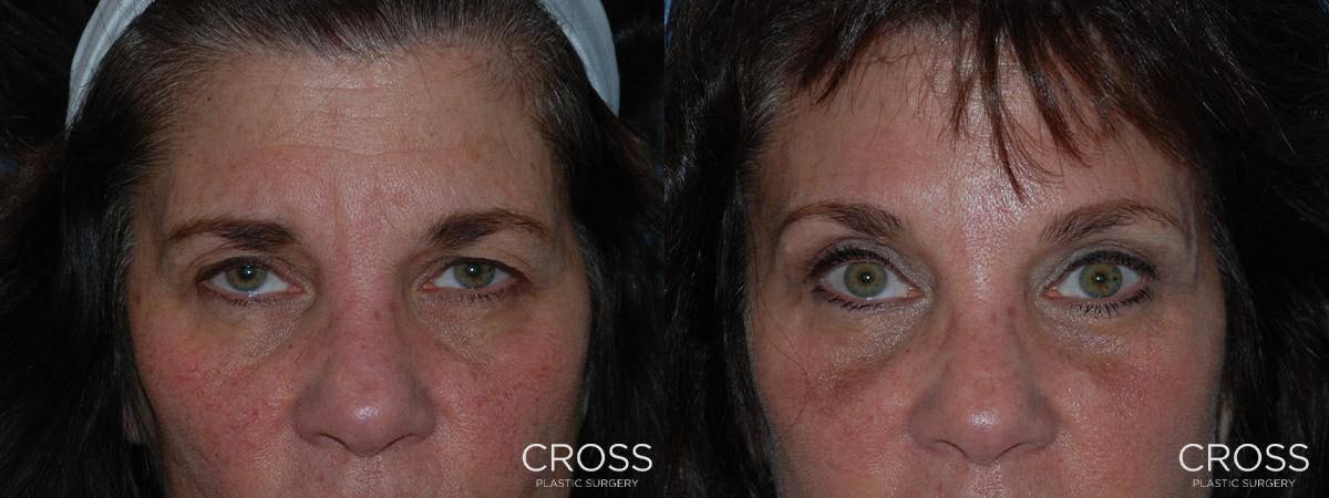 Cross Medical Group brow lift result — Philadelphia, PA