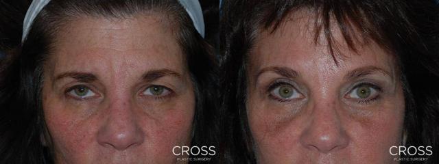 Brow Lift result at Cross Medical Group in Philadelphia, PA