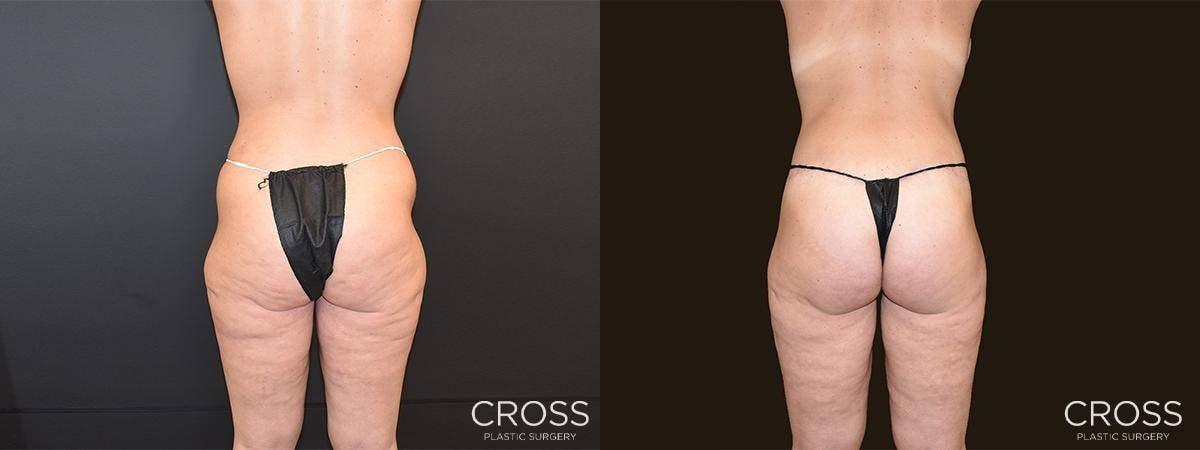 Cross Medical Group body lift result — Philadelphia, PA