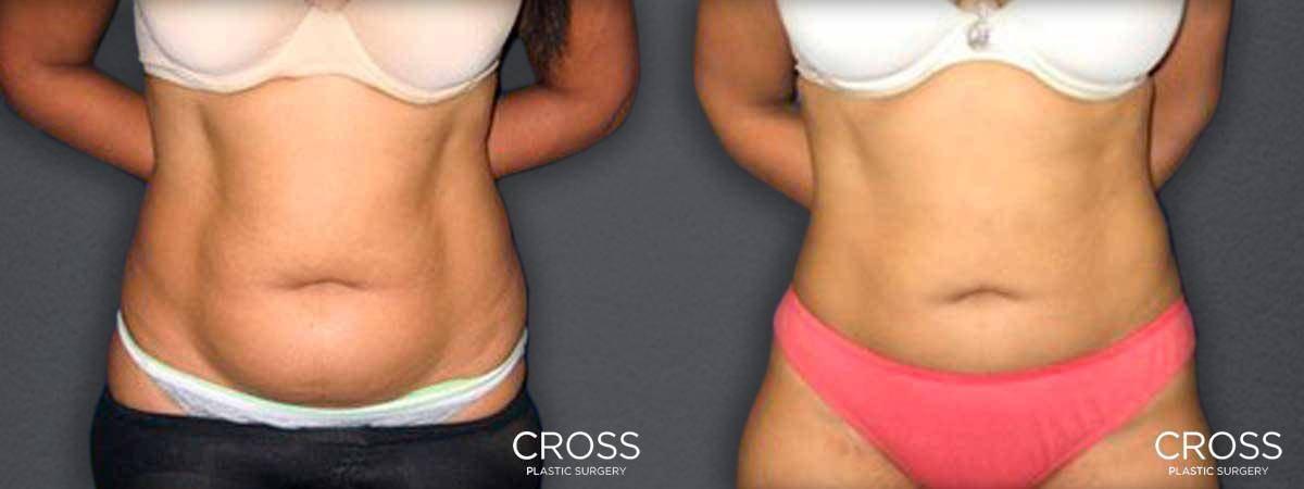 Cross Medical Group liposuction result — Philadelphia, PA