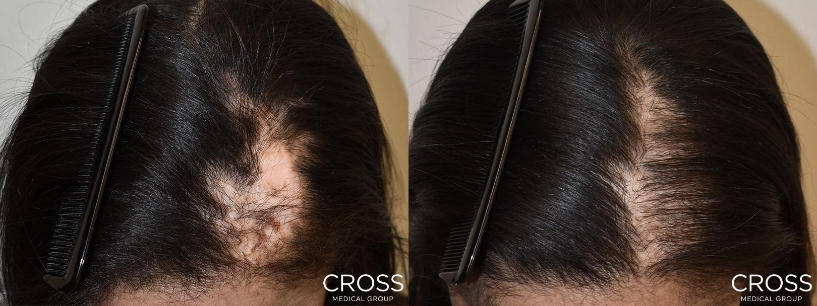 Cross Medical Group fue hair transplant result — Philadelphia, PA