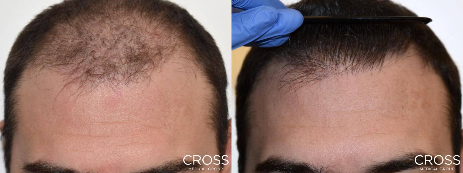 Cross Medical Group fue hair transplant result — Philadelphia, PA