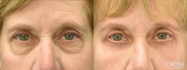 Blepharoplasty result at Cross Medical Group in Philadelphia, PA