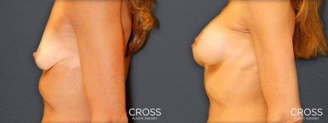 Breast Lift result at Cross Medical Group in Philadelphia, PA