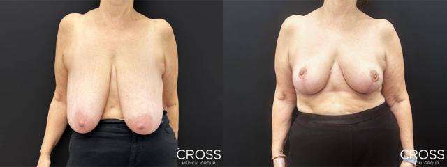 Breast Reduction result at Cross Medical Group in Philadelphia, PA