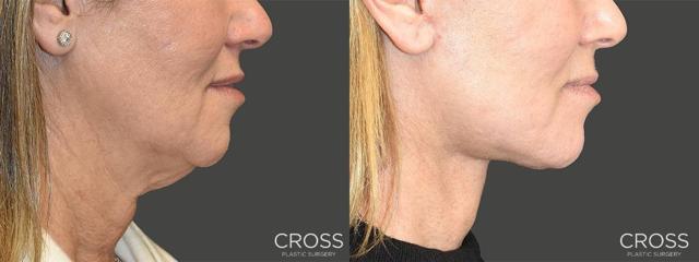 Neck Lift result at Cross Medical Group in Philadelphia, PA