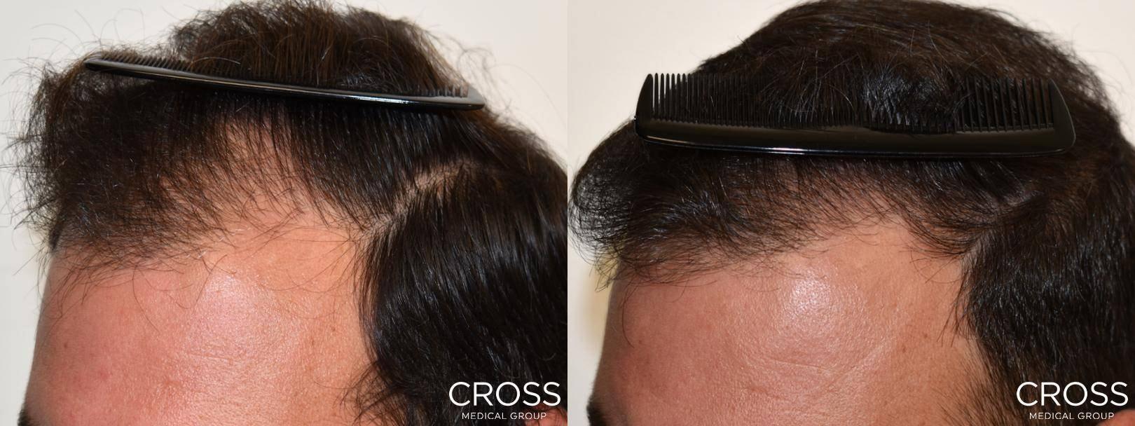 Cross Medical Group fue hair transplant result — Philadelphia, PA