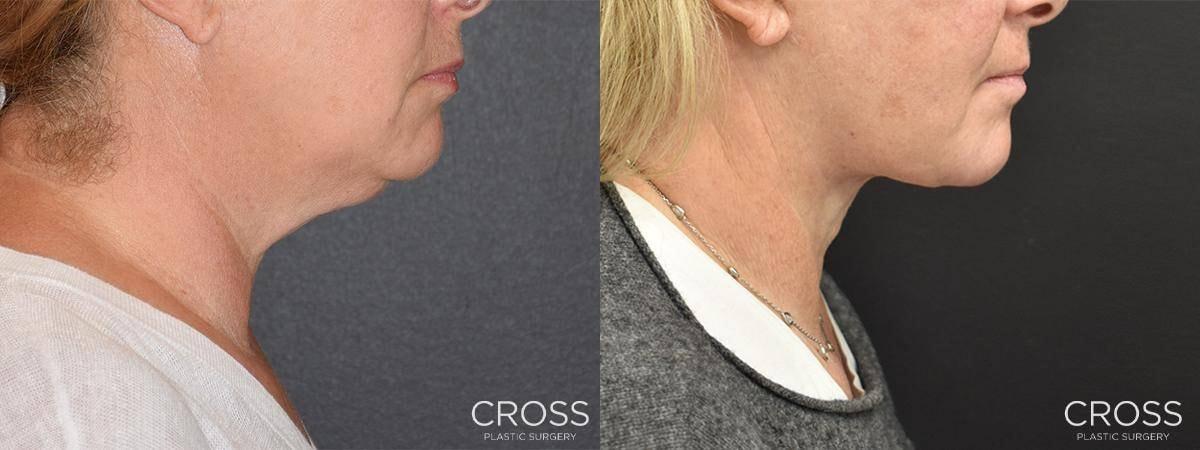 Cross Medical Group neck lift result — Philadelphia, PA