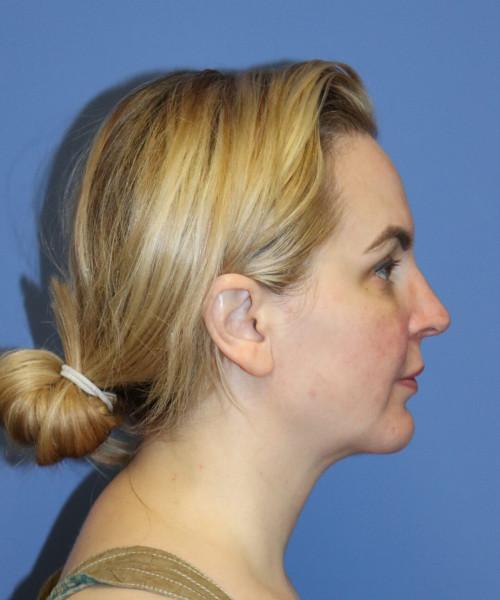 Bitner Facial Plastic Surgery of Utah liposuction after — Salt Lake City, UT
