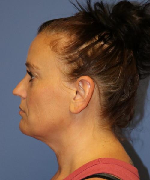 Bitner Facial Plastic Surgery of Utah liposuction after — Salt Lake City, UT