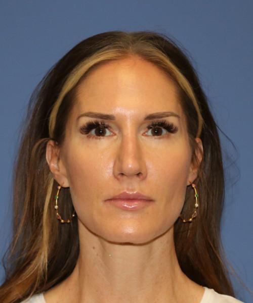 Bitner Facial Plastic Surgery of Utah rhinoplasty after — Salt Lake City, UT