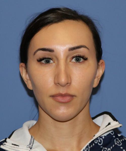 Rhinoplasty before at Bitner Facial Plastic Surgery of Utah in Layton, UT