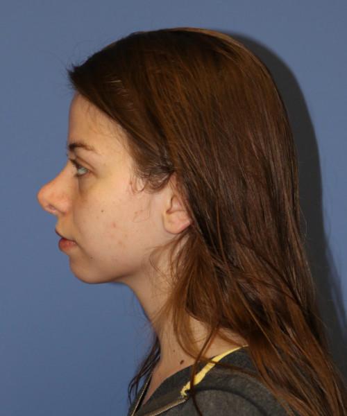 Rhinoplasty before at Bitner Facial Plastic Surgery of Utah in Salt Lake City, UT
