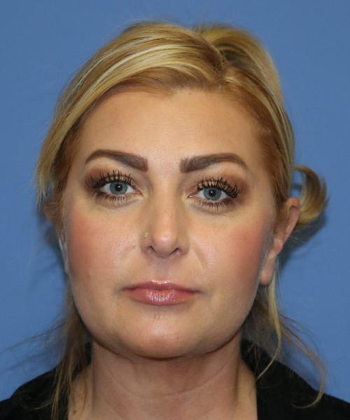 Bitner Facial Plastic Surgery of Utah skin tightening after — Salt Lake City, UT