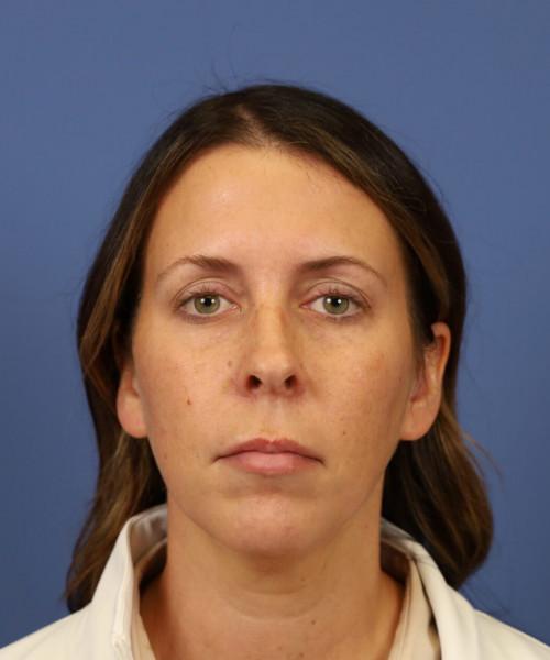 Chin Implant before at Bitner Facial Plastic Surgery of Utah in Salt Lake City, UT