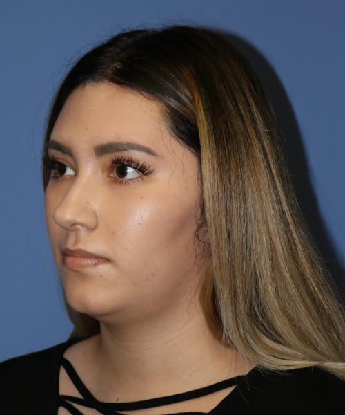 Rhinoplasty before at Bitner Facial Plastic Surgery of Utah in Layton, UT