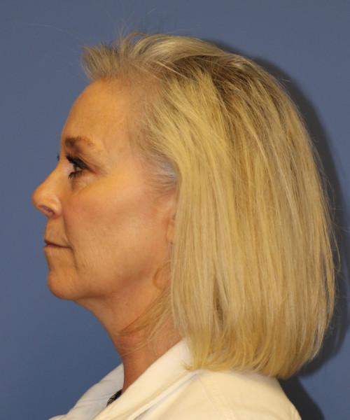 Rhinoplasty before at Bitner Facial Plastic Surgery of Utah in Layton, UT